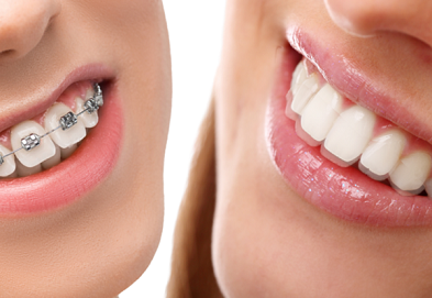 Invisible Braces Vs Metal Braces-Which is a better choice?