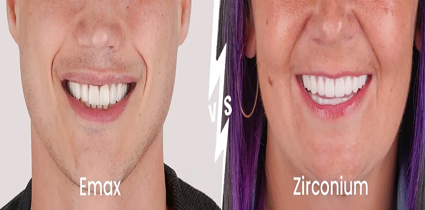 Emax vs Zirconia Crowns