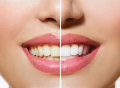 Teeth Whitening Solutions
