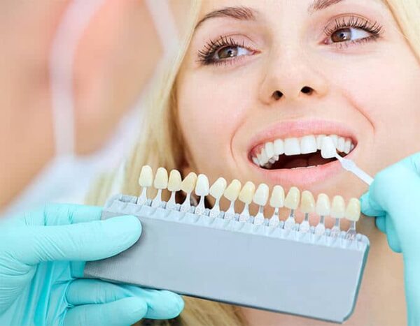 Dental Veneers