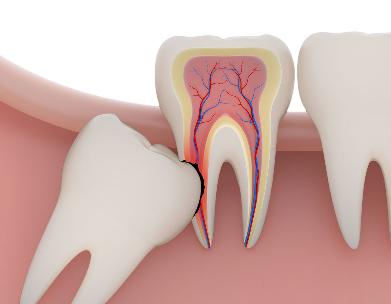 Wisdom Tooth Removal