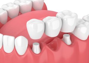Dental crowns and Bridges