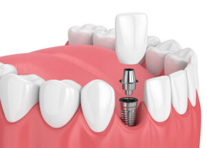 how dental implants placed