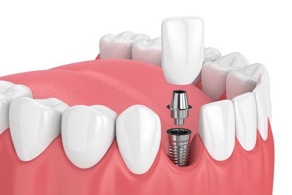 how dental implants placed