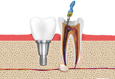 Image of Root canal