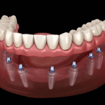 Digital Dentistry in Full Arch Rehabilitation